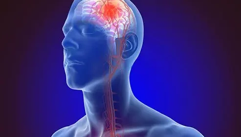 Top Warning Signs of Stroke You Should Never Ignore | MICU
