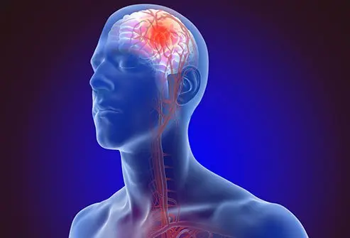 Top Warning Signs of Stroke You Should Never Ignore | MICU